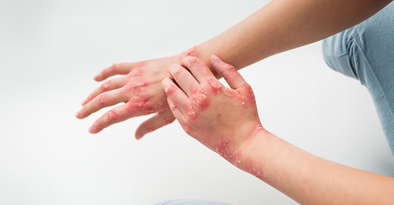 Psoriasis: Causes, Symptoms