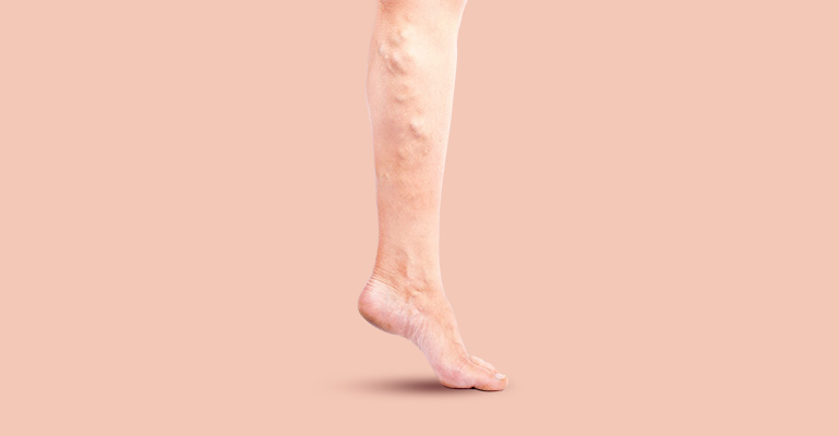 How to Manage Varicose Veins Naturally